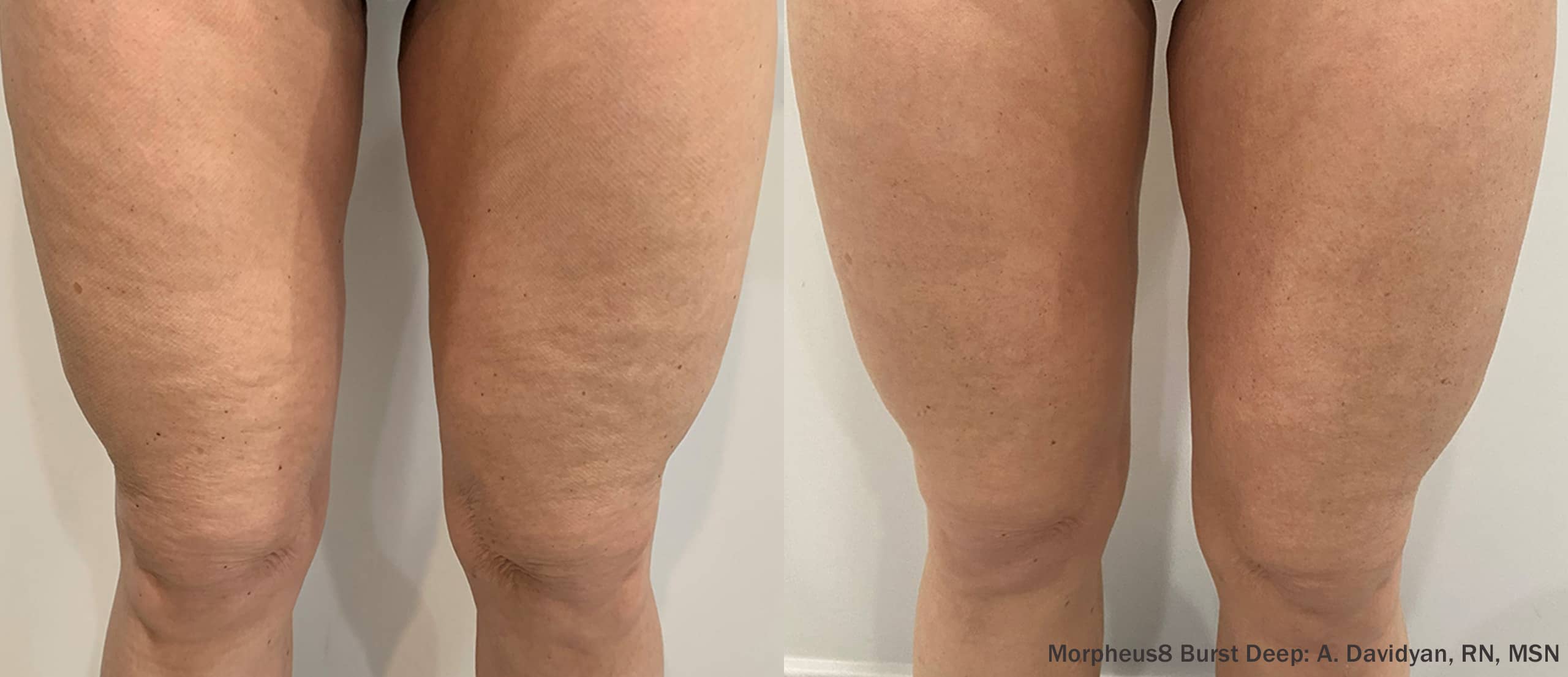 680413420f8de0d527284e6d_LA Beauty Skin Center_M8BD_Thighs_3Months-TM