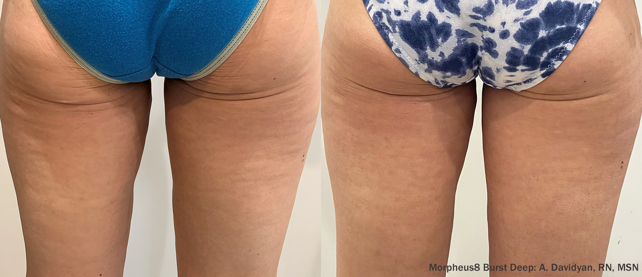 68041342d131189a4fc921a2_LA Beauty Skin Center_M8BD_Buttocks_Thighs_3Months-TM