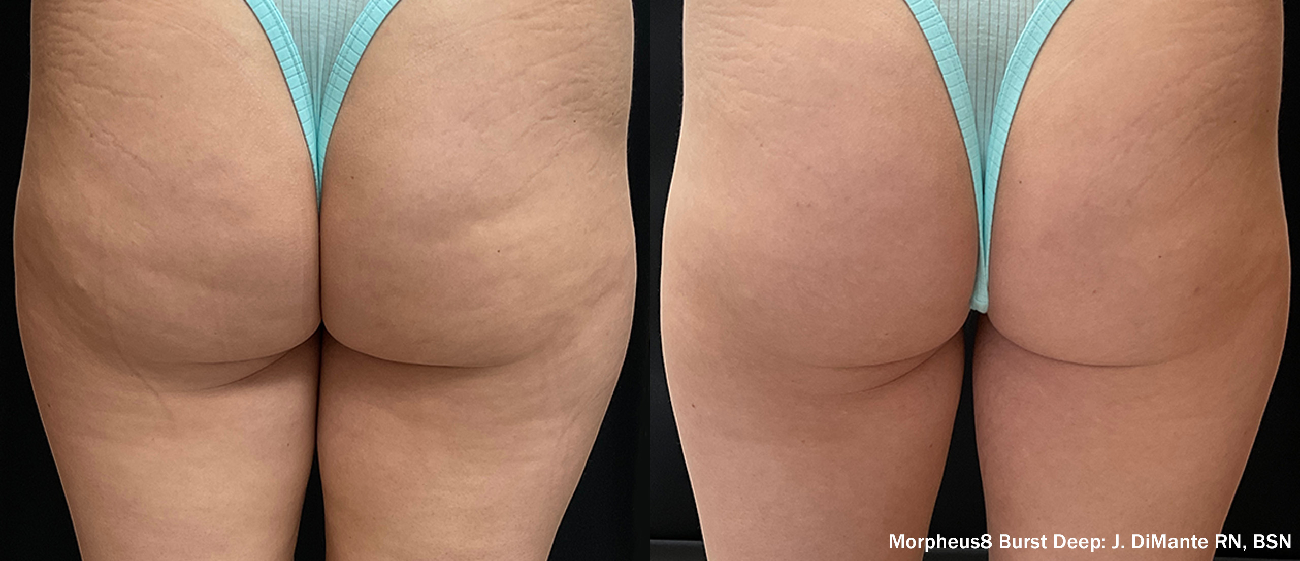 68041342f2a870b1d262c8b3_DiamondAesthetics_M8Body_Buttocks-TM