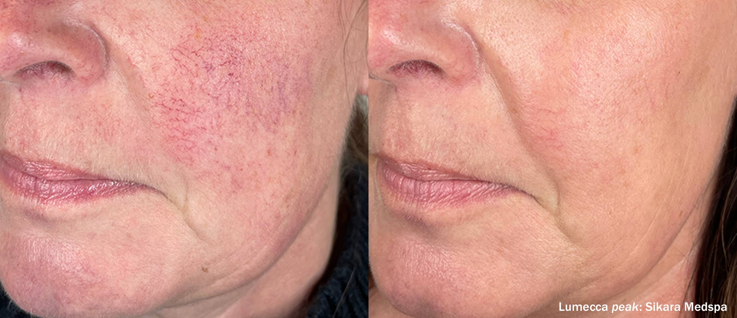 680419138d47b543c15b5526_Sikara Medspa_LumeccaPeak_LSide_Angled-TM