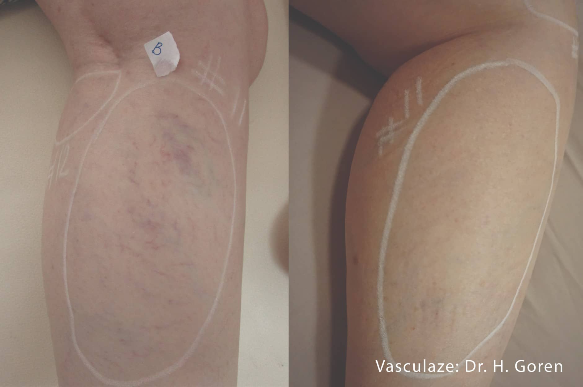 6807e9f172db74e6ab3906a1_Vasculaze_Before&After (6) (1)